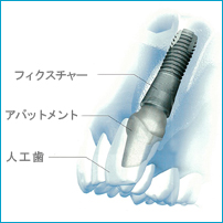 インプラント治療ってどんなもの？